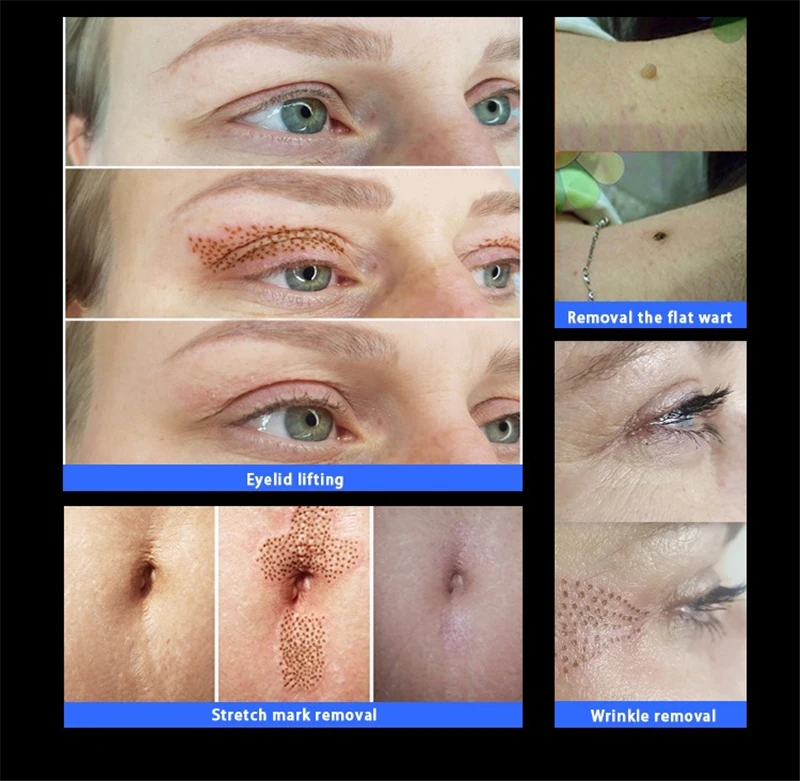 4Th Maglev Plasma Pen Eyelid lifting Laser Plasma Tattoo Freckle Dark Spot Remover Wart Removal Skin lifting tightening