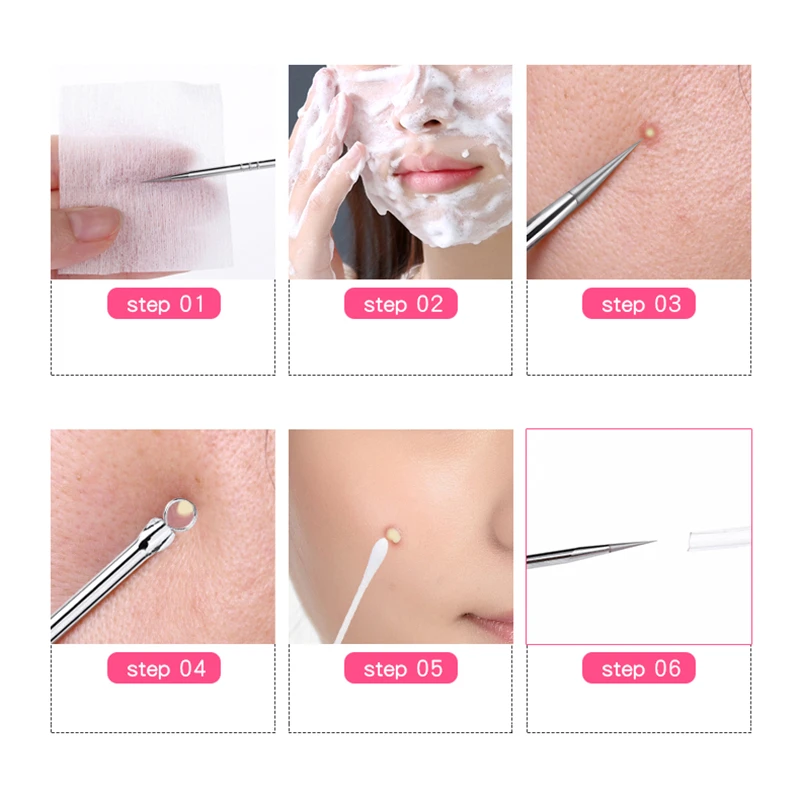 1 Pcs Meeëter Comedo Acne Puistje Blemish Extractor Remover Rvs Naalden Verwijder Gereedschap Gezicht Huidverzorging Porie Schoner