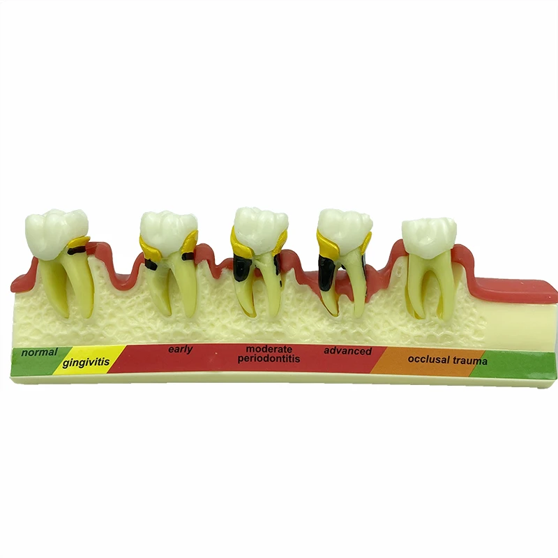 Dental 5-Stage Periodontal Disease Dentoform Typodont Dental Teaching Model Patient Communication Model