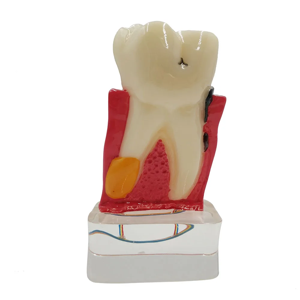 4:1 Dentist Dental Study Teach Tooth Model Teeth Disease Model