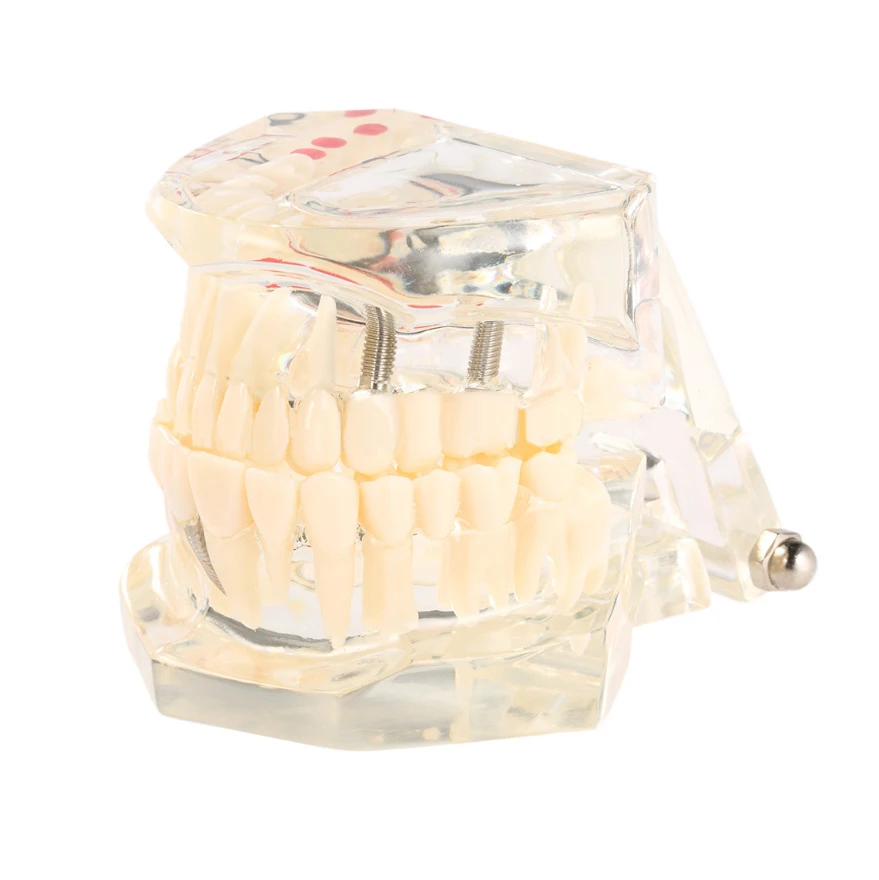 Transparent Dental Model Implant Restoration Bridge Tooth Disease Teaching Analysis Removable Teeth Demonstration Model