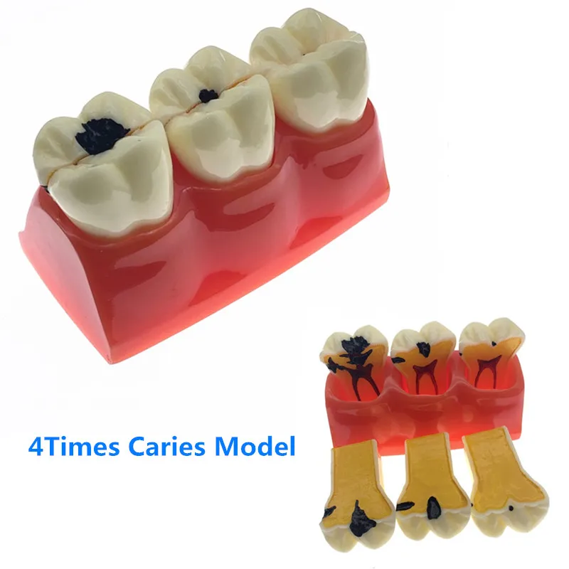 

4Times Caries Models Caries teeth model for showing the progress of caries,fistula Teaching Research Model