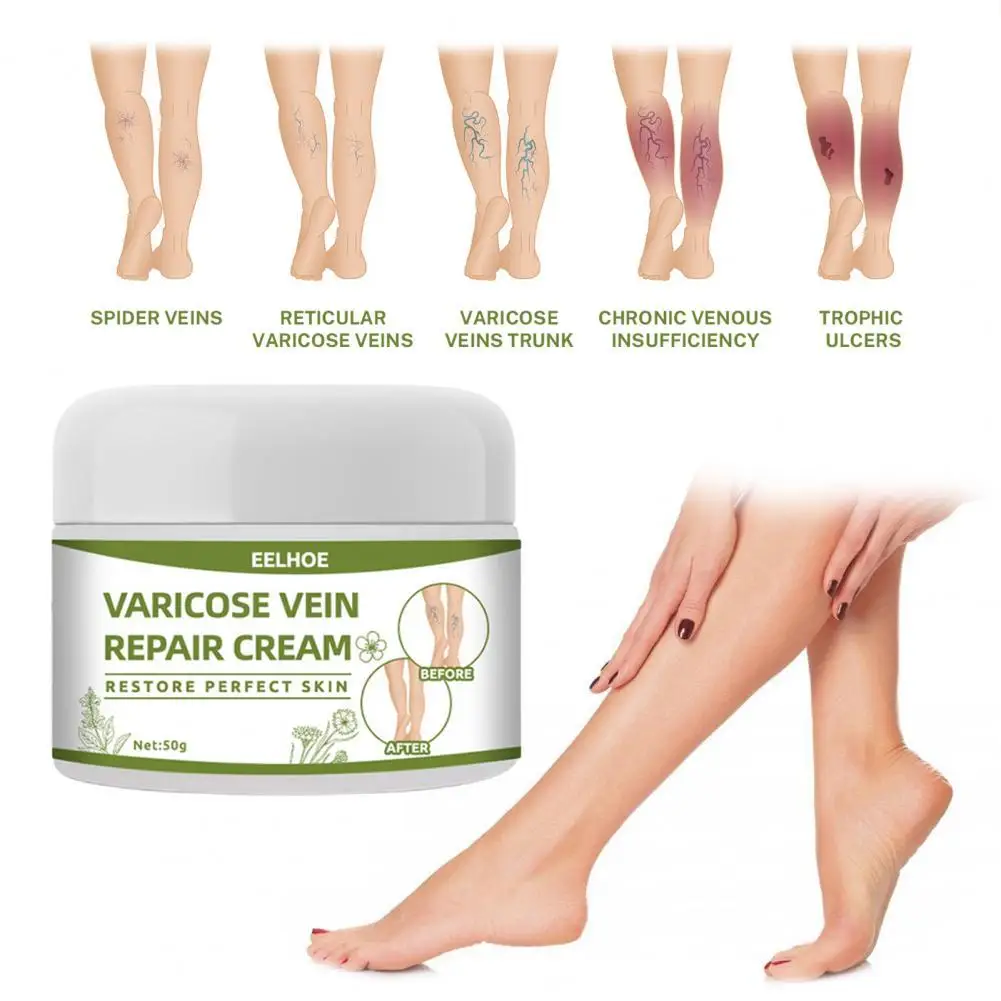 

50g Spider Leg Gel Effective Convenient Plant Extracts Varicose Vein Repair Cream for Postpartum Obese People