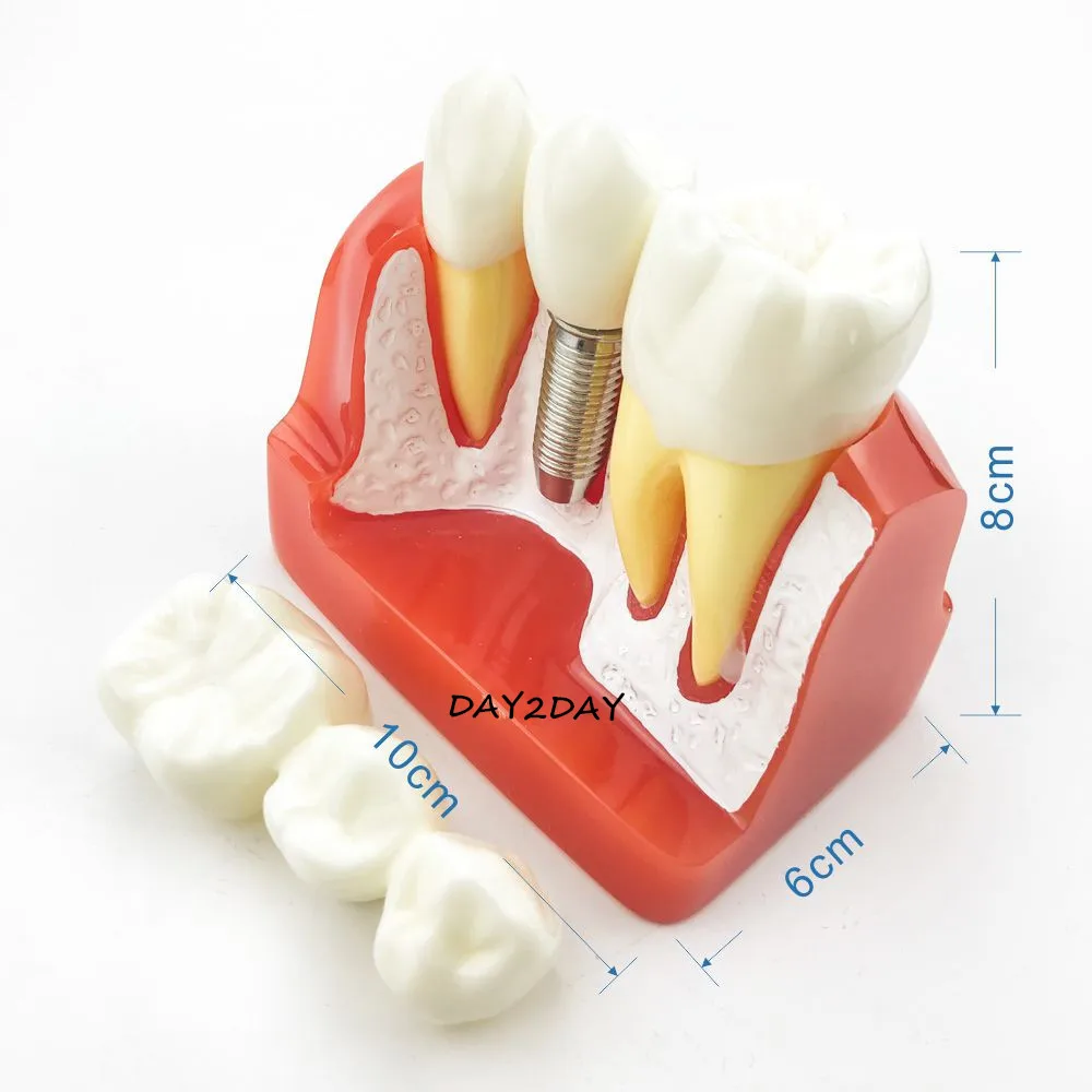 Modelo educacional de boca #2017, ensino dental, ponte removível para educação oral