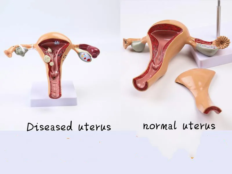 

Female Anatomy Reproductive Uterus Model Vaginal Ovary Model Teaching Mold Disease Change Science Teaching Aids Biology