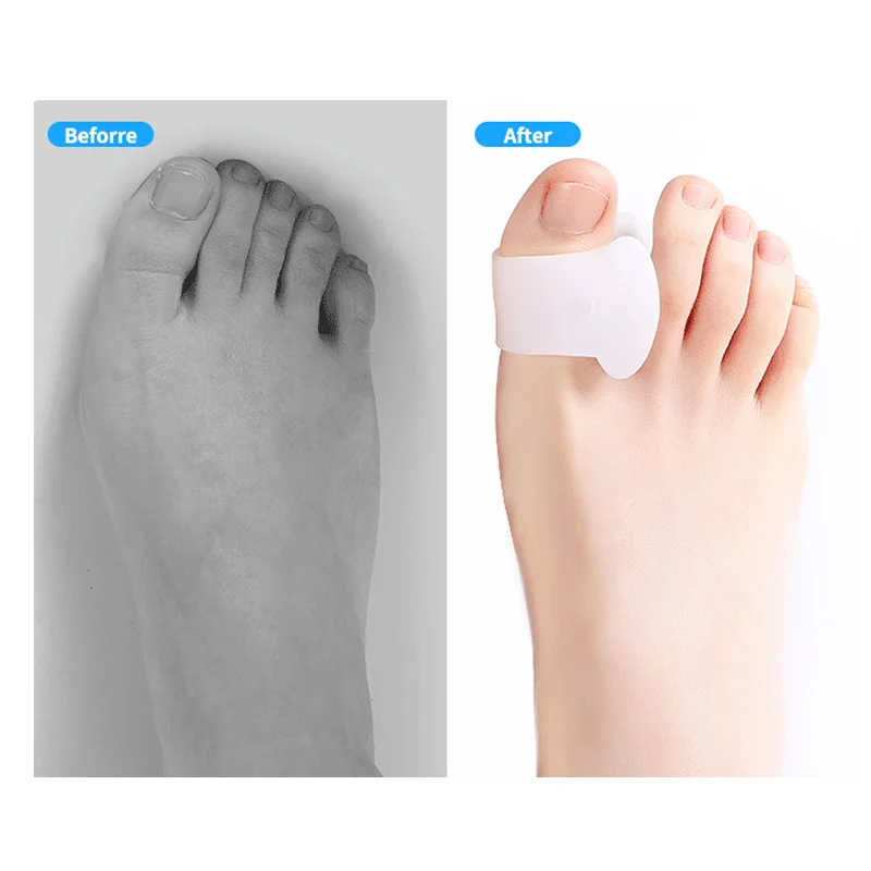 2Pcs=1Pair Silicone Gel Big Toe Separator Bunion Adjuster Foot Fingers Protector Bone Hallux Valgus Corrector Foot Care Pedicure