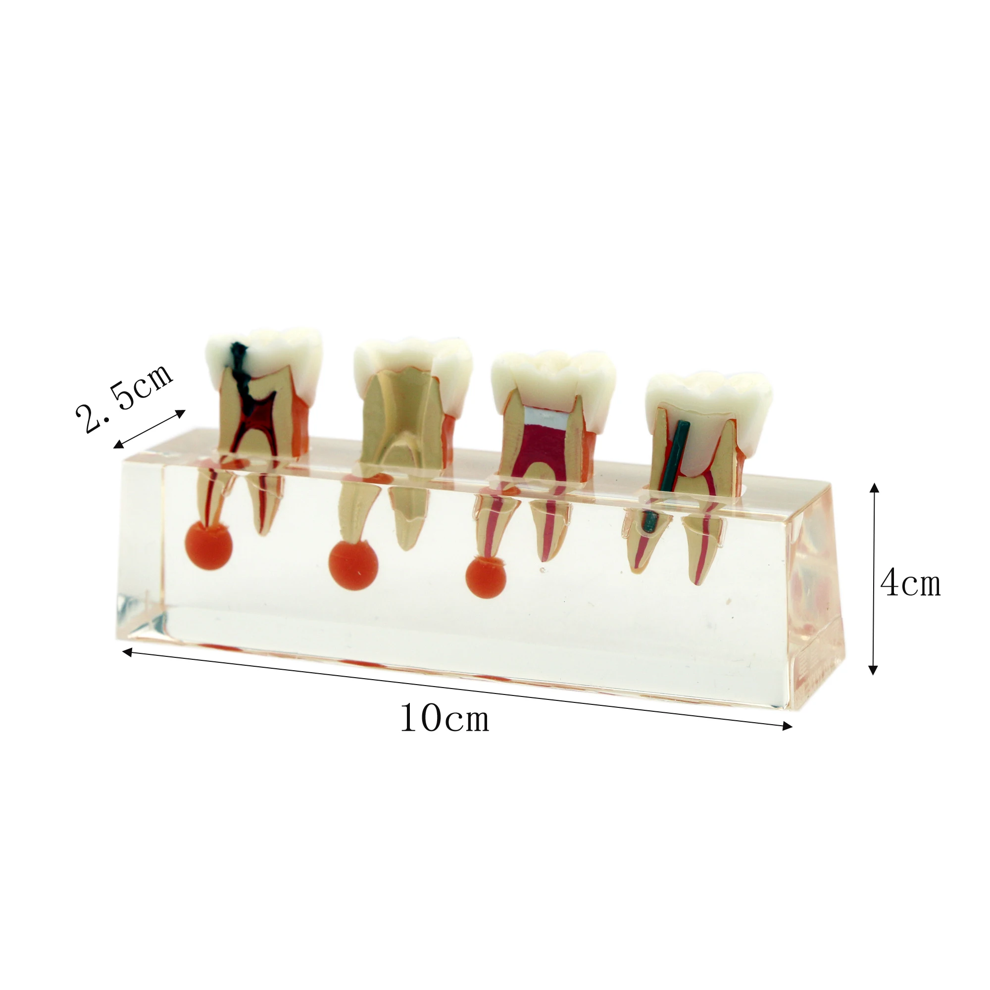 Dental Teeth Model 4-Stage Endodontic Treatment Clear Demonstrates Model for Study Teaching Clinic Decoration