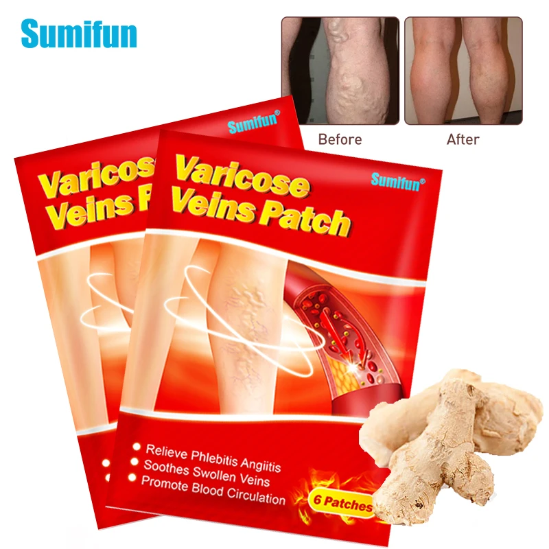 

12pcs Sumifun Varicose Veins Patch Vasculitis Phlebitis Spider Leg Removal Sticker Varicosity Angiitis Herbal Medical Plaster