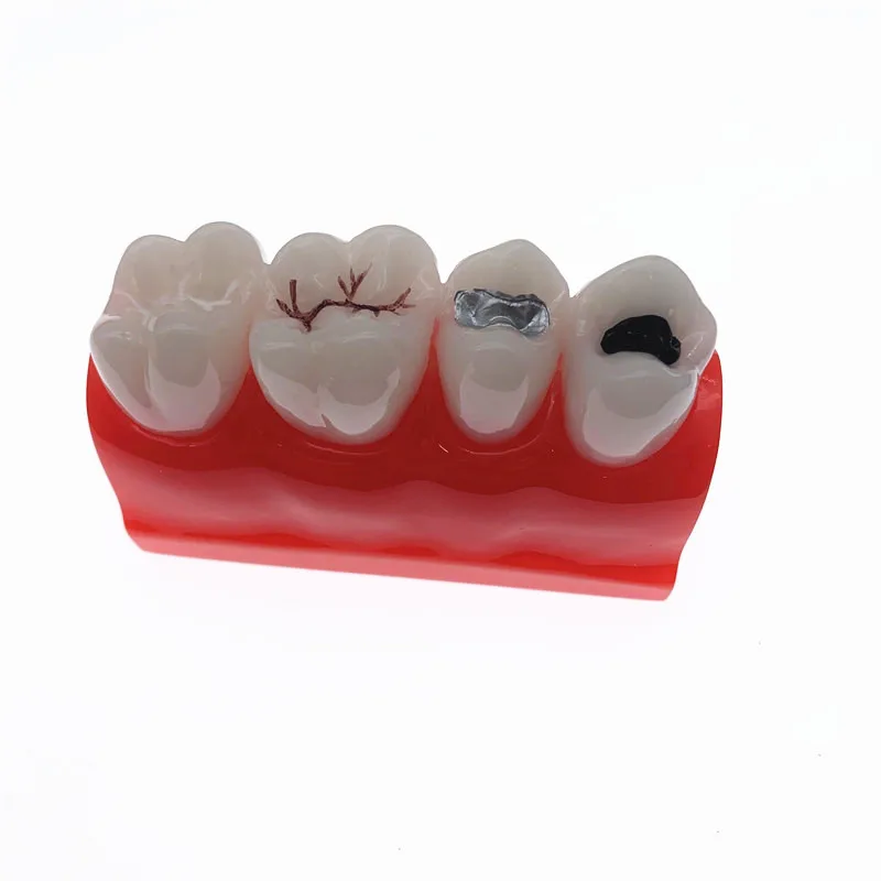 Teaching Resources Dental Study Model for Pit and Fissure Sealing Treatment Teeth Model