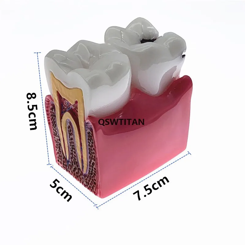 Teeth Model Caries Comparation Study Models 4Times/6times Caries model Teaching research model for dentistry students