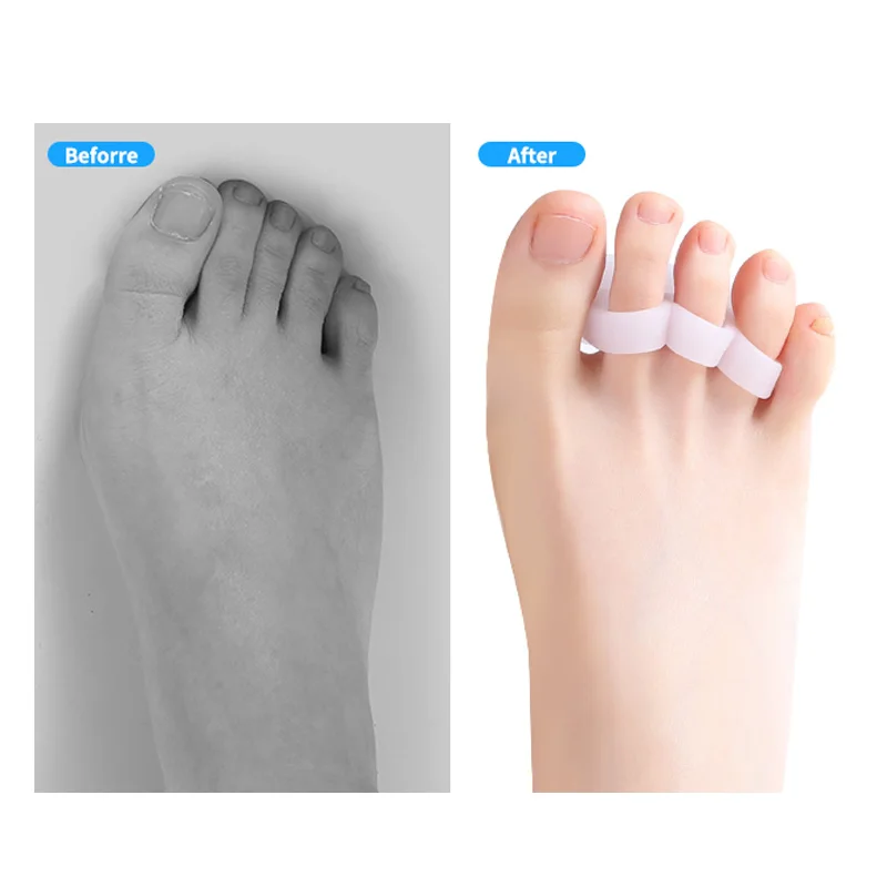 Hammer Toe Treatment Soft Gel Splints to Prevent Overlap Support Pads Straightener and Corrector for Mallet Toes Curling Relief