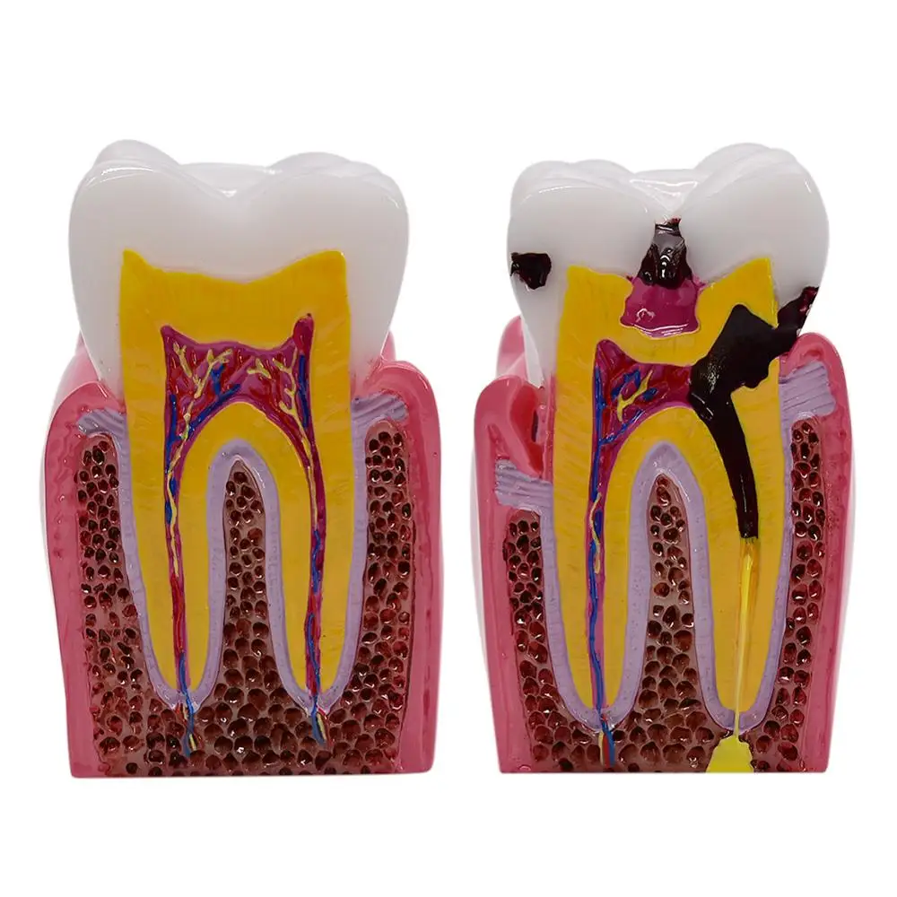 1pc 6 Times Dental Caries Comparsion Models Tooth Decay Model For Dental Study Teaching Dental Anatomy Education Teeth Model