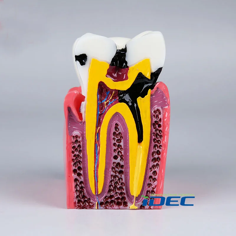 Teeth Model Caries Dental Demonstration Dentist  Patient Communication Models 1pc