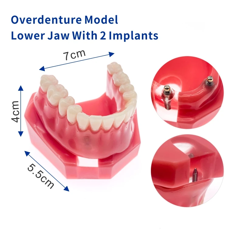 

Dental Inferior Implant Overdenture 6007 Teeth Model 2 Implants Teeth Model