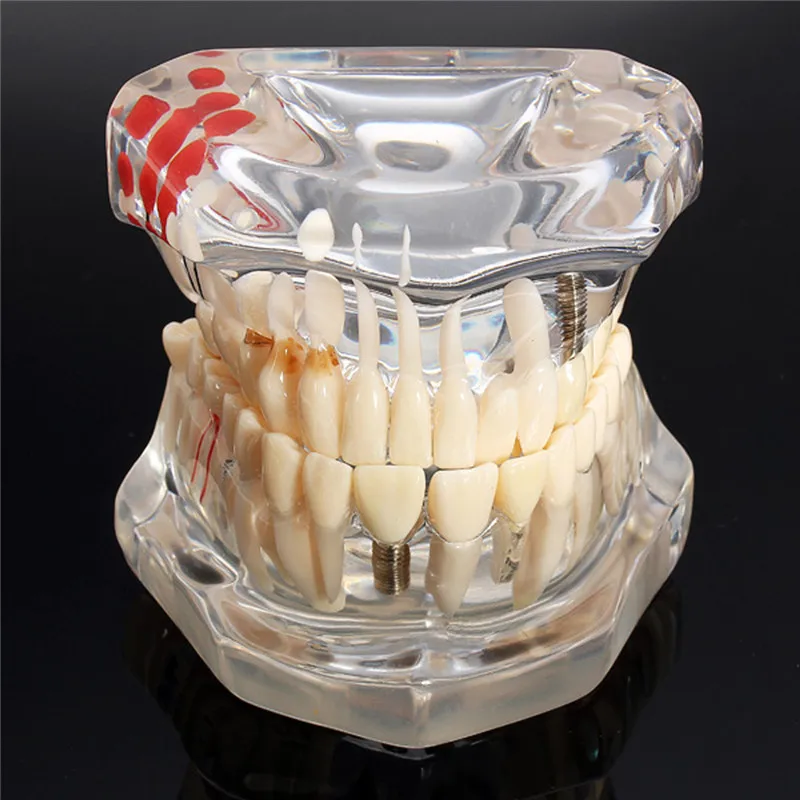 Implant Dental Disease Teeth Model with Restoration Bridge Tooth Dentist for Medical Science Dental Disease Teaching Study Tool