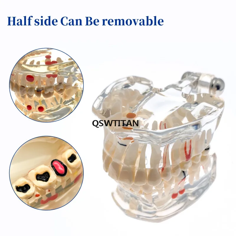 Teeth Model Transparent Adult /Children Pathological Teeth Model Doctor-Patient Teaching