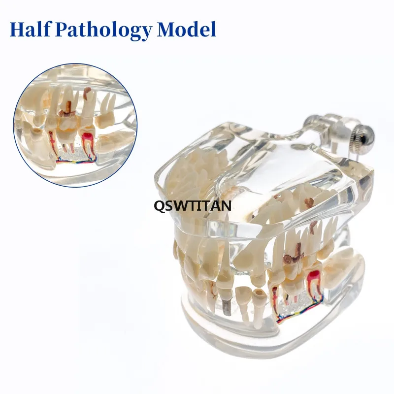 Teeth Model Transparent Adult /Children Pathological Teeth Model Doctor-Patient Teaching
