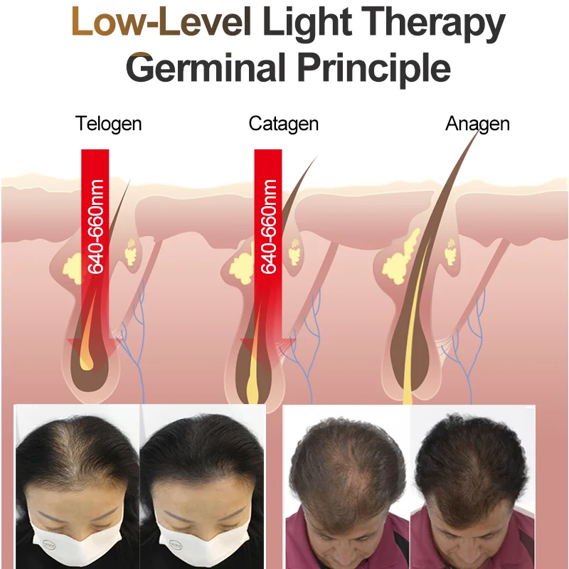 Capacete De Crescimento De Cabelo A Laser, Terapia LLLT, Estimular O Folículo Capilar, Tampão De Restauração De Cabelo De Regeneração