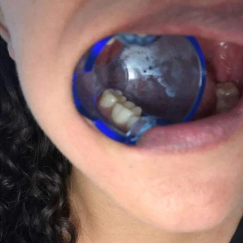 Imagen 2 del producto Retractor de mejillas Intraoral Dental, abridor de labios y boca, blanqueamiento Dental para dientes posteriores anteriores