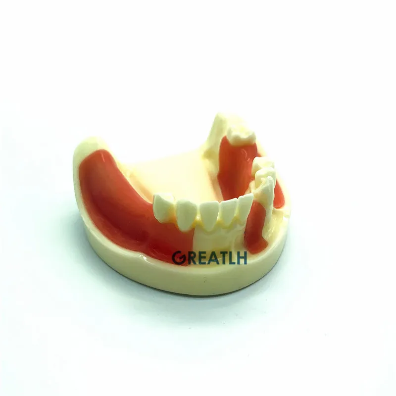 Dental Implant Practice model Lower Jaw model with missing teeth for cutting and suturing Typodont Teeth Model with Gingiva