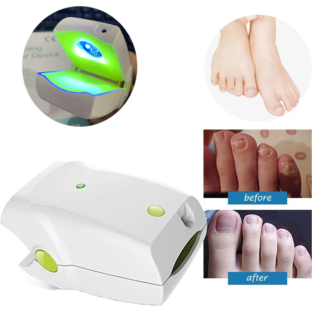 Dropshipping Clean Nail Fungus Device 905nm Laser Light therapy Nail Infection Treatment Nail Repair Solution