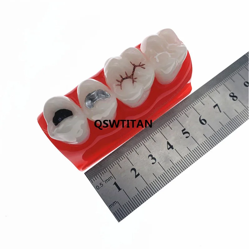 Teaching Resources Dental Study Model for Pit and Fissure Sealing Treatment Teeth Model