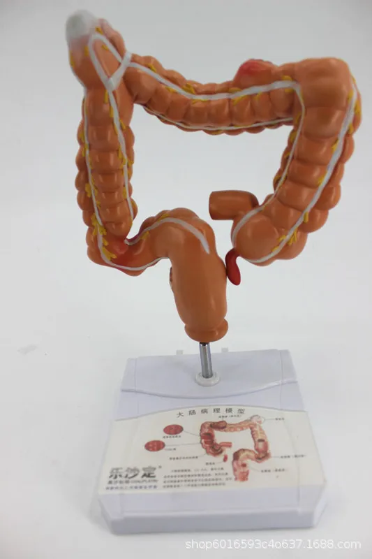 1:1 Life Size Anatomy Human Colon Pathology Model Colorectal Lesions Specimens Intestinal  Organs Medical Teaching Simulation