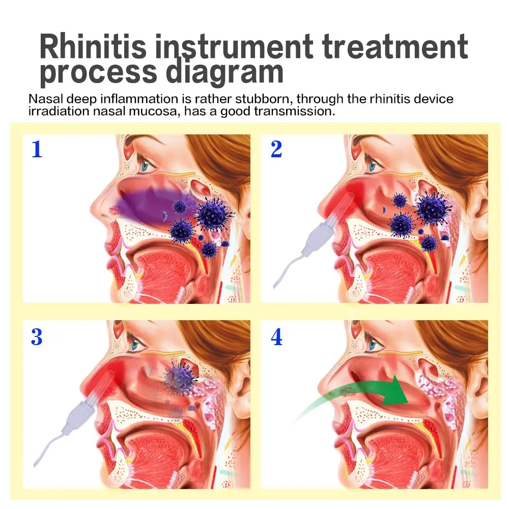 Rhinitis Sinusitis Cure BioNase Nose Treatment Nose Cure Massage Hay Fever Low Frequency Pulse Laser Health Care Dropshipping