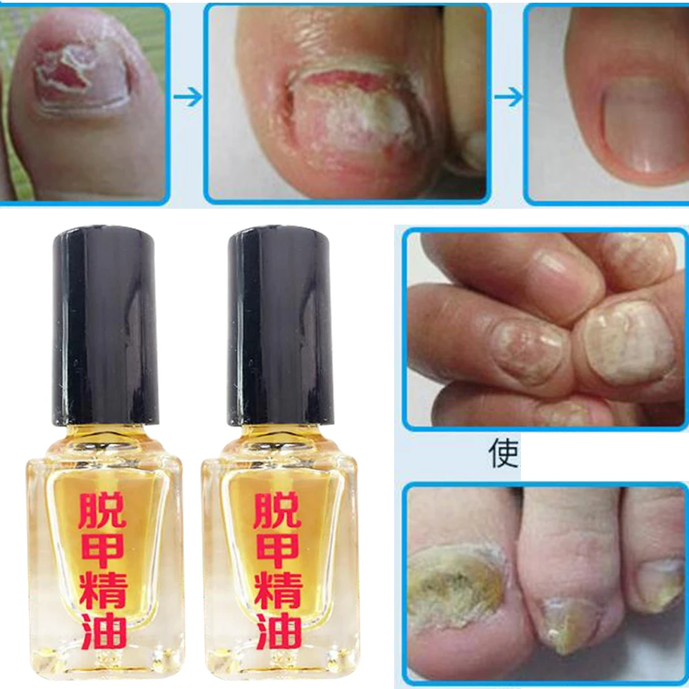 2/4/6/10pcs 곰팡이 제거 에센스 액체 곰팡이 네일 트리트먼트 NailRepair Anti Infection Foot Caring Onychomycosis