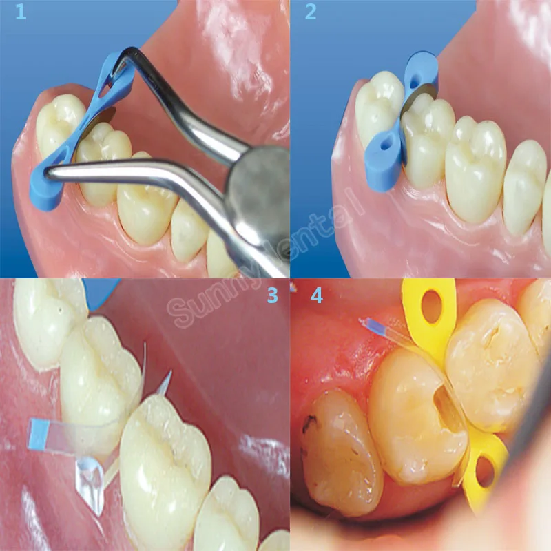30 teile/schachtelDental Transparente Schnitt Konturierte Matrizen Breite 7mm Schmale 5mm Matrix Polyester Russische Matrizen Zahnarzt Werkzeuge – Detail 2