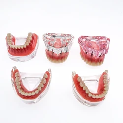 Modelo de dentes dentários com implantes Overdenture, Modelo Demo Superior para Estudante, Comunicação do paciente dentista