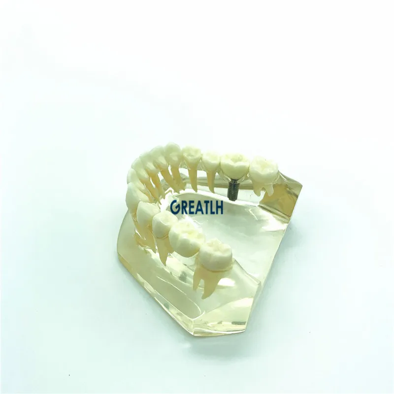 

Dental Implant Teeth Bridge Model Typodont showing implant fixtures dental Lower Jaw teeth study dentristy communication model