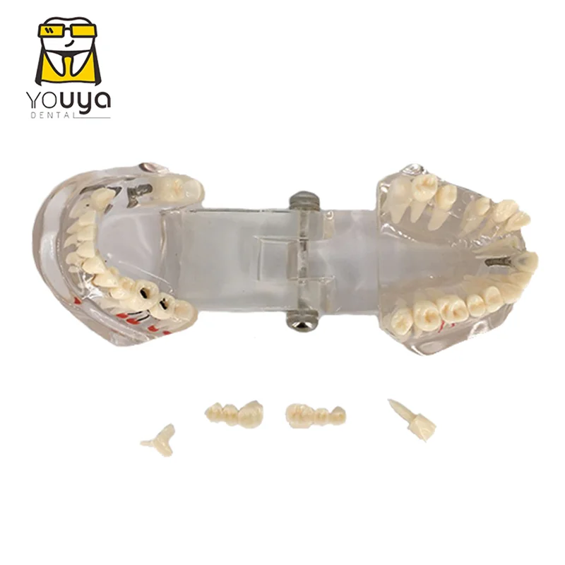 Transparent Disease Teeth Model Dental Implant Teeth Model Dentist Dental Student Learning, Teaching, Research Communication