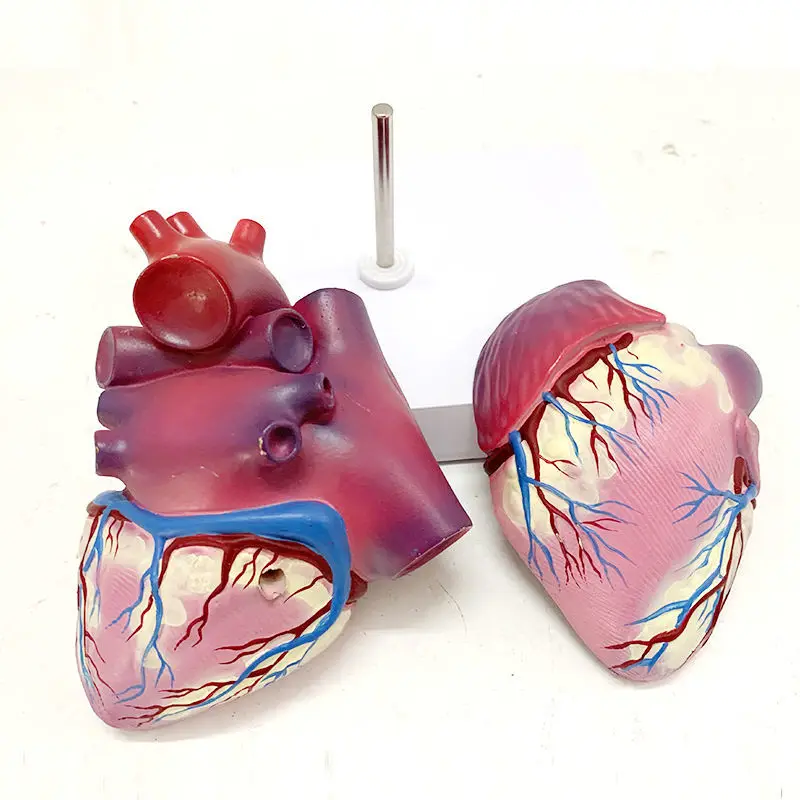 Human Atherosclerosis Thrombosis Heart Disease Model Anatomy Heart Structure Internal Pathology Visceral Heart Valve