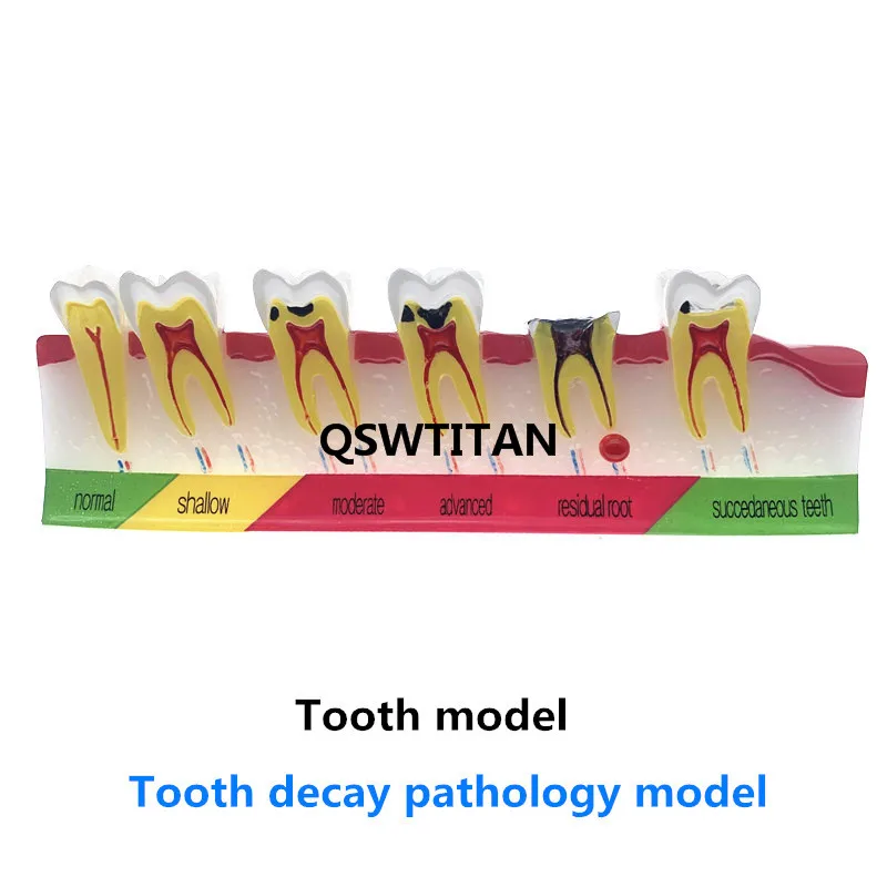 Dental caries classify model Tooth Model Demonstration Teach Study Dental teeth caries Evolution decayed tooth Analysis Model