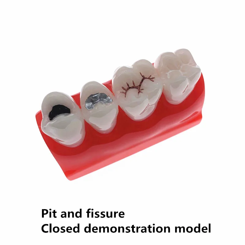 

Dental Study teeth Model Dental pit and fissure closed model Treatment Teeth Model