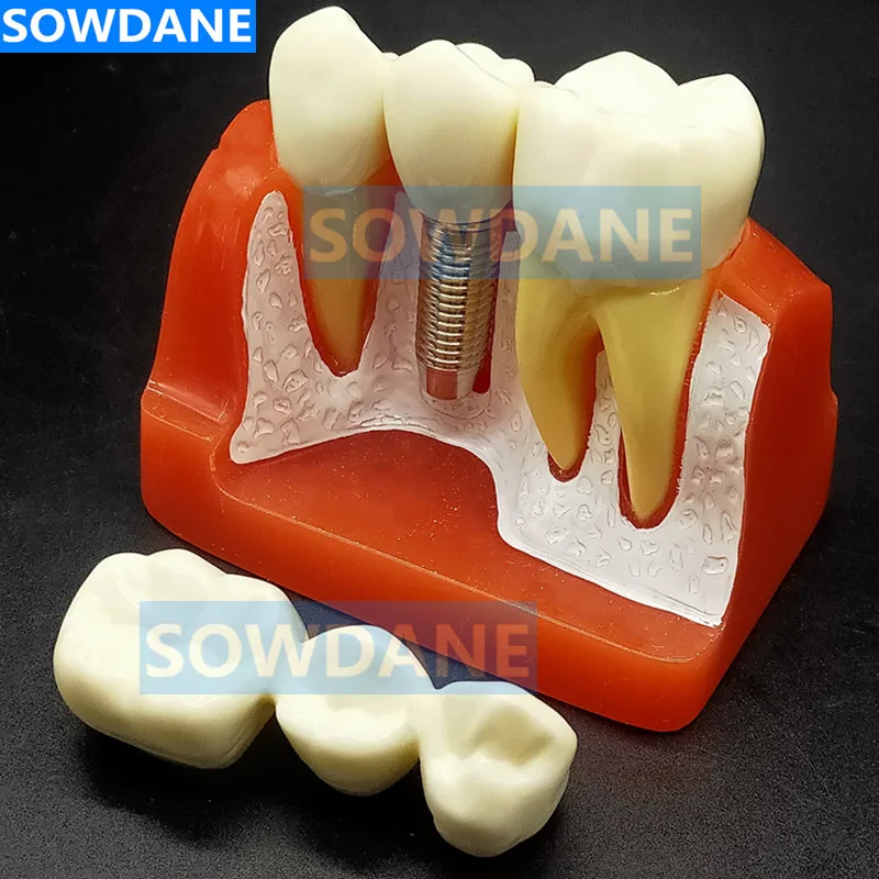 

4 Times Dental Implant Disease Analysis with Restoration Crown Bridge Demonstration Dental Teeth Teaching study Model