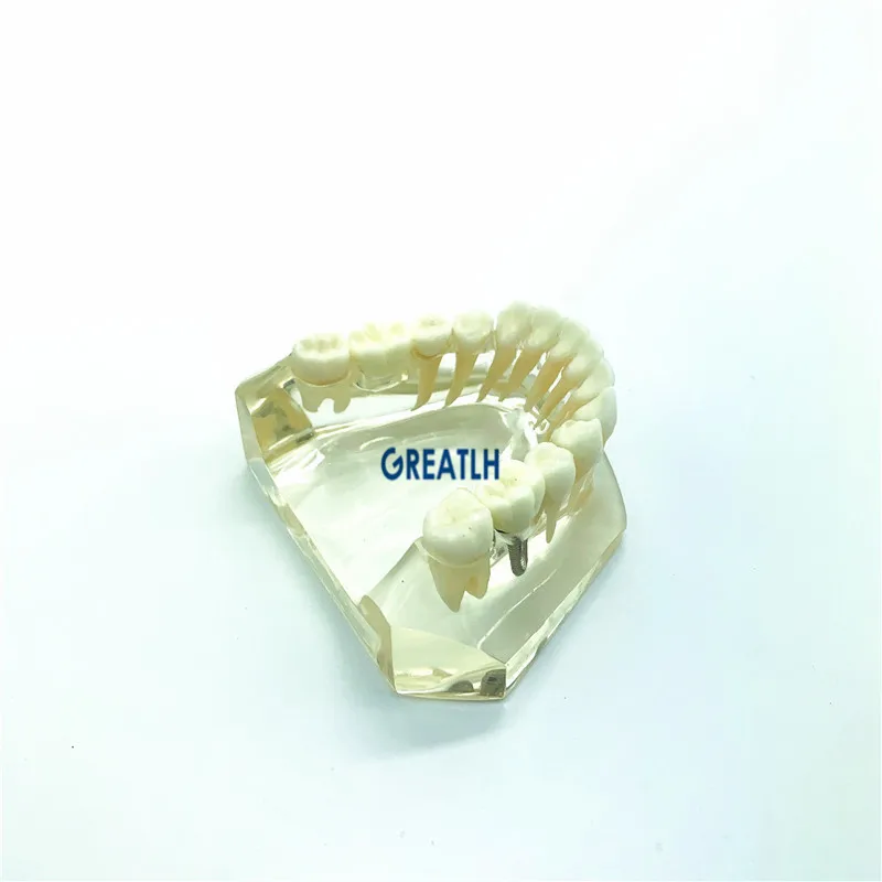 dental Lower Jaw teeth Implant Dental implant fixtures Bridge Model Typodont dental school learing study model