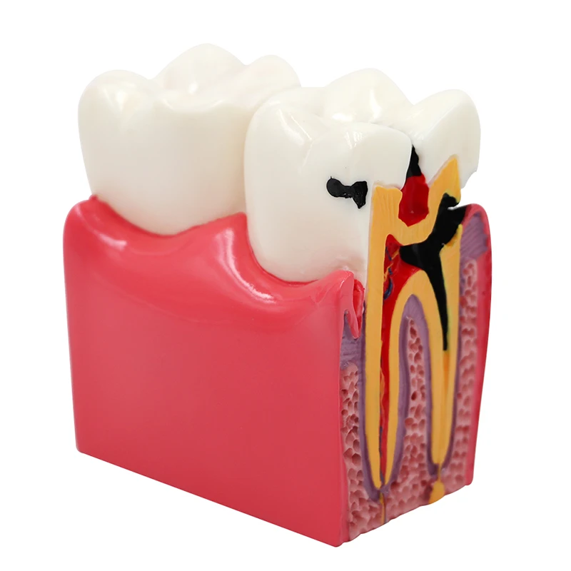 Dental Decayed Teeth Model Teaching Anatomy Education Teeth Model 6 Times Caries Comparation Study Researching Tooth Model