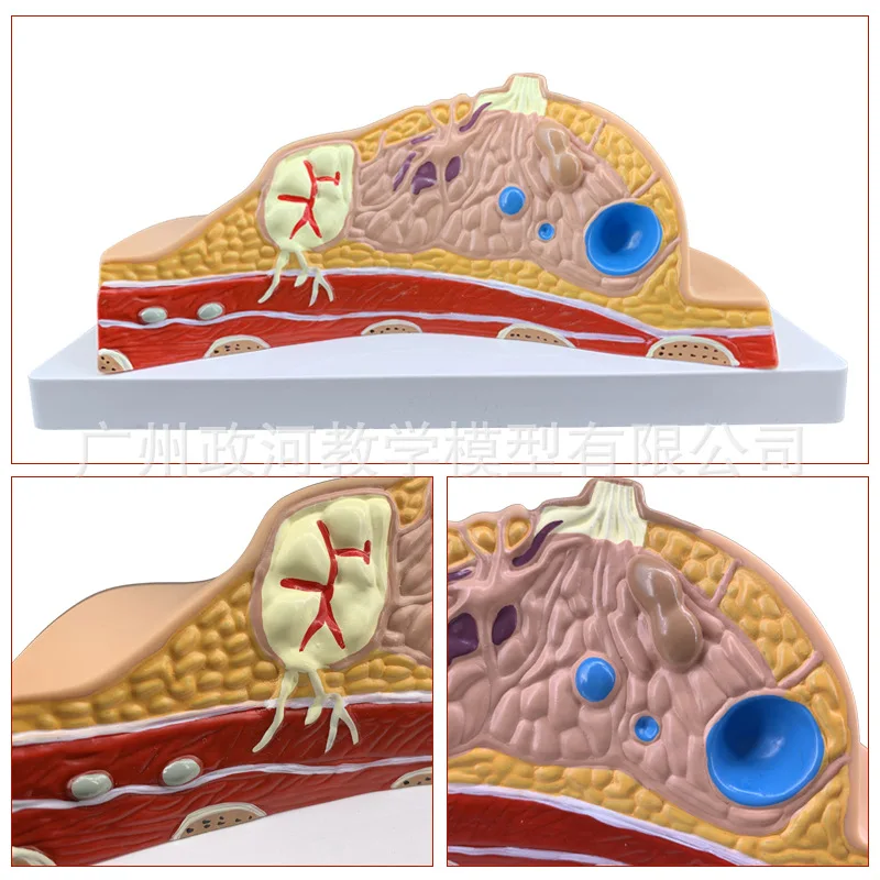 Breast Lesion Model Human Breast Model Environmentally Friendly Non-toxic Material Breast Model Human Medical Science 16x13x12cm