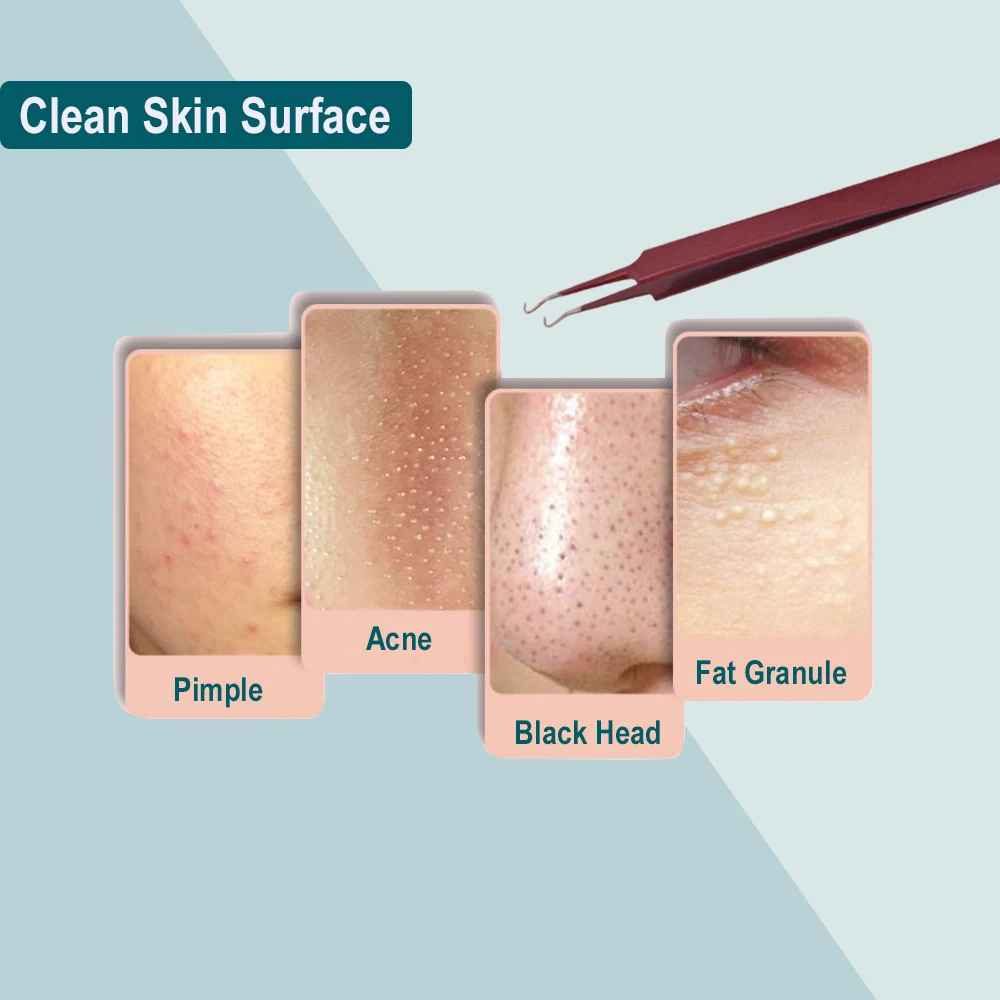 Инструмент для ухода за кожей из нержавеющей стали, средство для чистки лица, экстрактор черных точек, средство для удаления комедонов