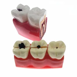 Modelo de dientes para estudiantes de odontología, modelo de estudio de comparación de Caries, 4/6 veces