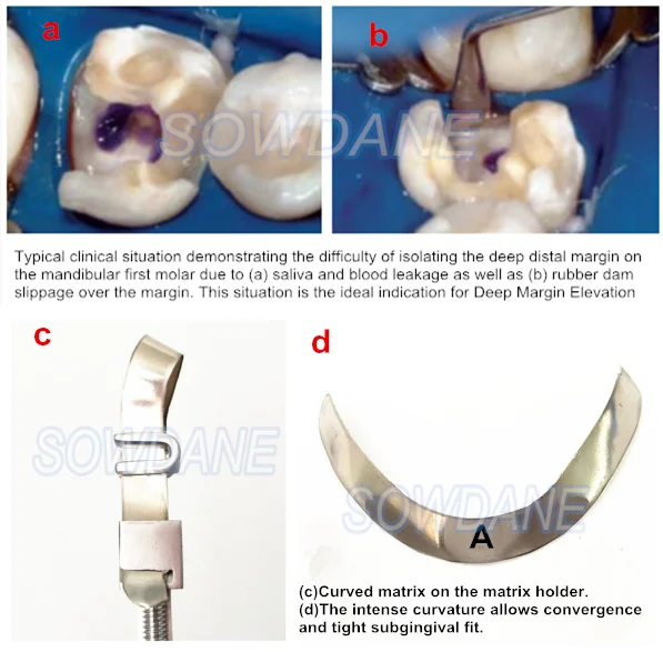 Dental Tofflemire Matrix for Deep Margin Elevation Large Curvature Matrices Retainer Sectional Contoured Matrice Dental Material