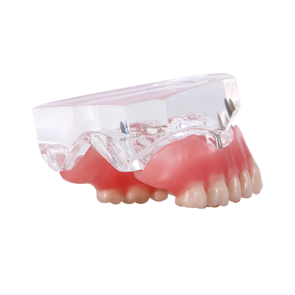 Modelo Mandibular Dental Removível com Implante, Dentes Overdenture, Dentes Superior e Inferior, Dente Ensino e Estudo