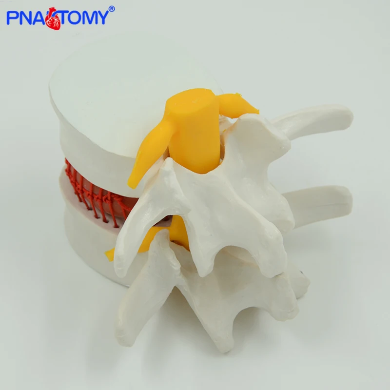 Dysk lędźwiowy przepuklina Model nauczania traumatyczne pistolet przybory szkolne przyrządy medyczne ludzki kręgosłup anatomia szkielet powiększ