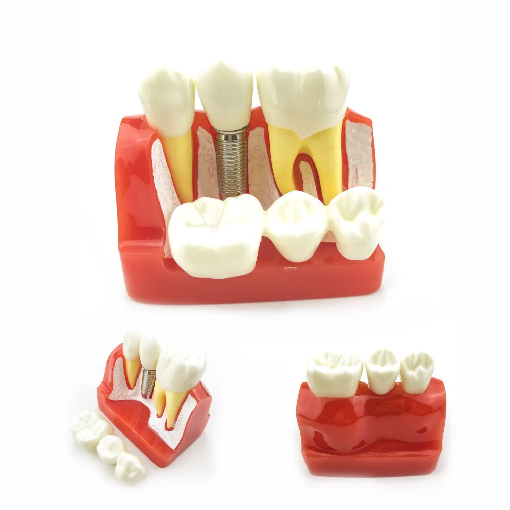 Dental Teach Implant Analysis Crown Bridge Removable Model Oral Education Teeth Model#2017 Dentist Equipment