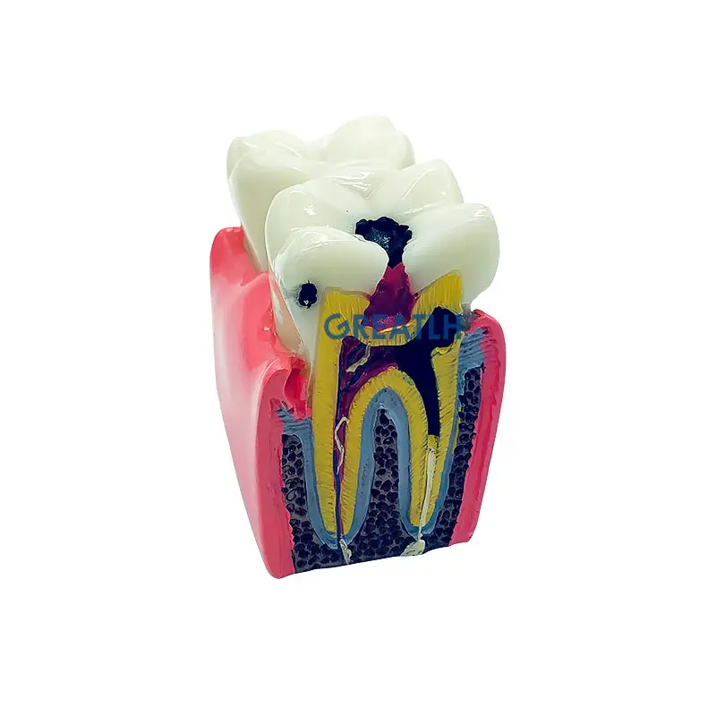 Teeth Model Teeth Disease Teaching Model Caries Model Dental Model Dentistry Products