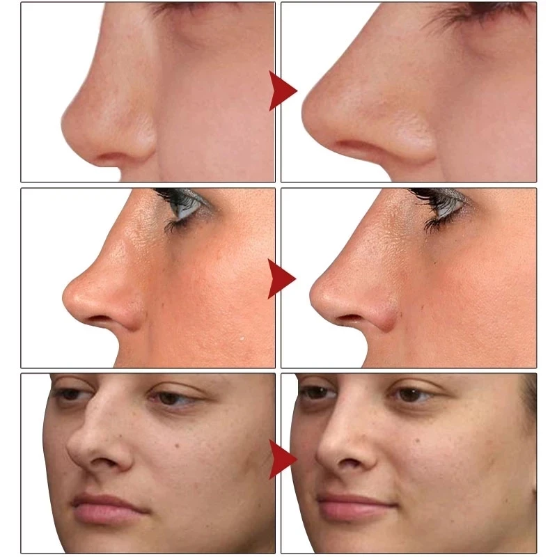 Nose Up Heighten Rhinoplasty Essential Oil Nasal Bone Rmodeling Pure Natural Nose Care Thin Smaller Nose 100% Effective