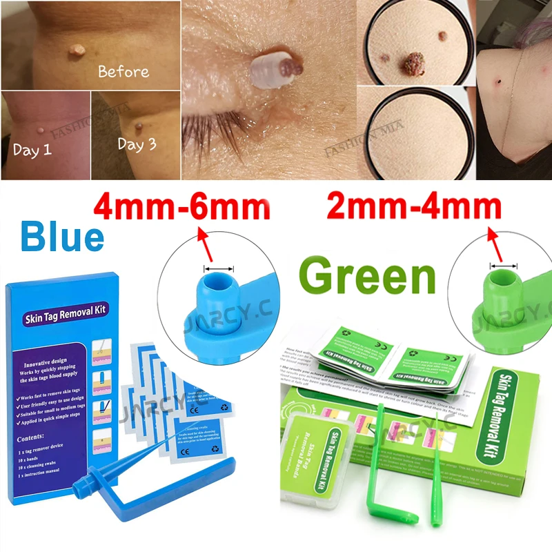 Skin Tag Removal Kit Papillomas Treatment Skin Cleansing Tools Micro Band 4-6mm For Berrugas Warts Remove Mole Wart Face Care