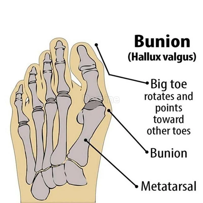 Bàn Chân Trước Miếng Lót Chỉnh Hình Miếng Lót Thoáng Khí Co Giãn Gel Lót Bàn Chân Trước Orthotic Móng Chân Bảo Vệ Tay Miếng Lót Giảm Đau Chân